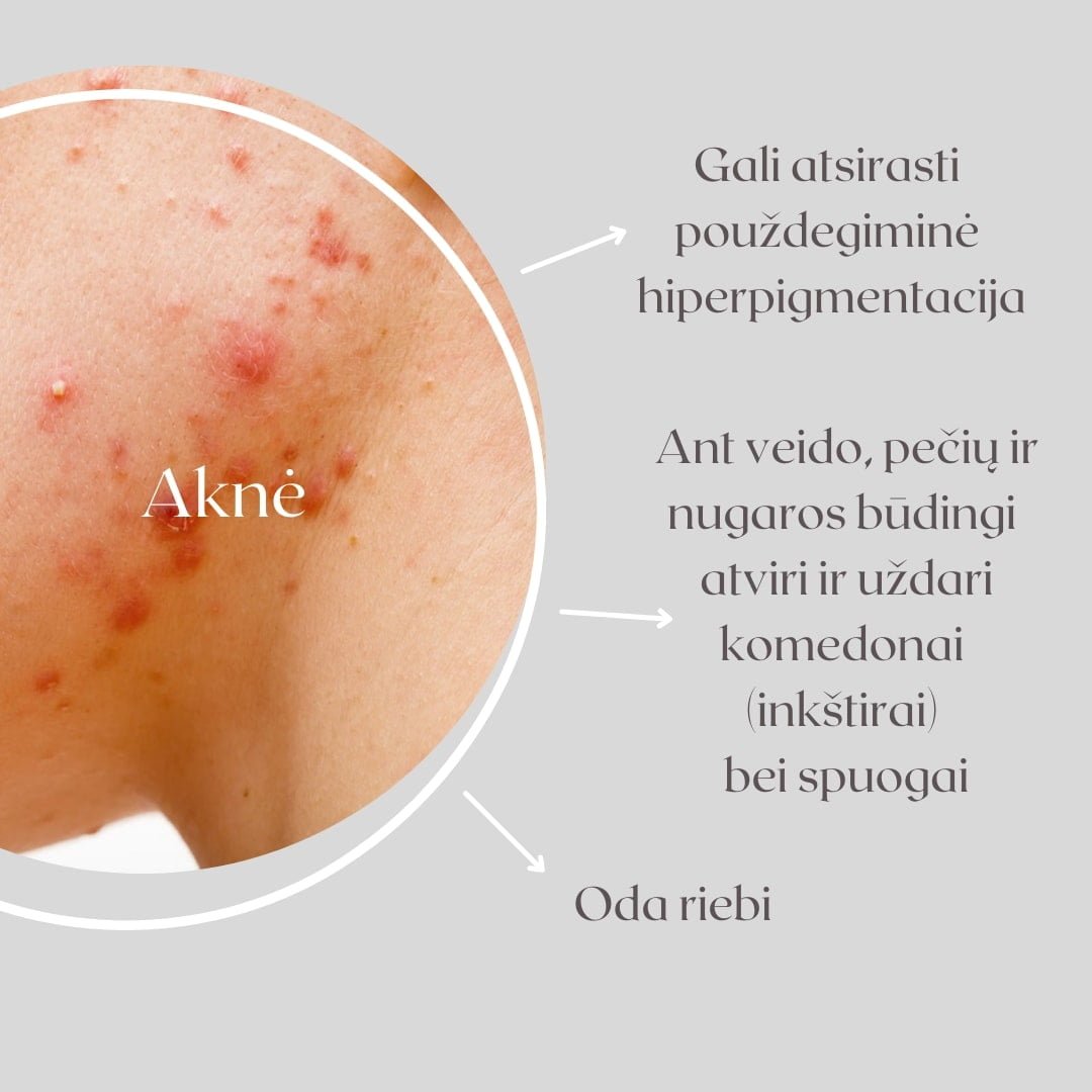 kaip kovoti su berimais spuogais akne problemines odos prieziura paaugliu oda